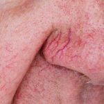 What Is Alcoholic Nose (Rhinophyma)?