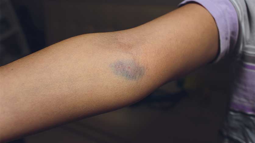 Missed Shot Arm bruise from injecting drugs - Shooting Up Errors | How To Know When You Missed